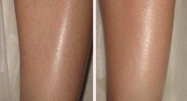 Photoepilator for hair removal at home: contraindications and consequences